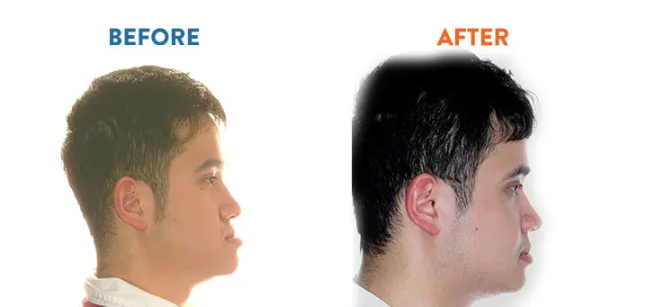 Jaw Realignment - Before & After