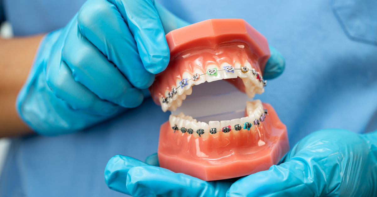 Braces FAQs: Everything You Need to Know Before Getting Braces in Springfield, VA