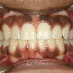 amara-teeth-after