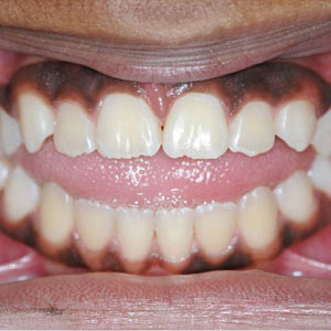 amara-teeth-before
