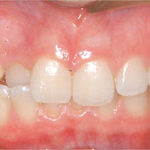 charlotte-teeth-before