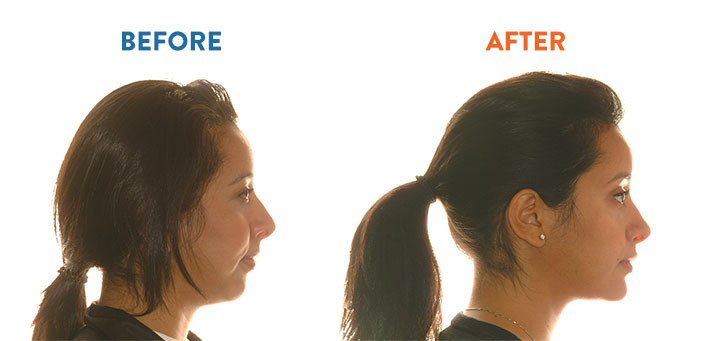 Hudson Orthodontics - Before and After Orthodontic Treatment
