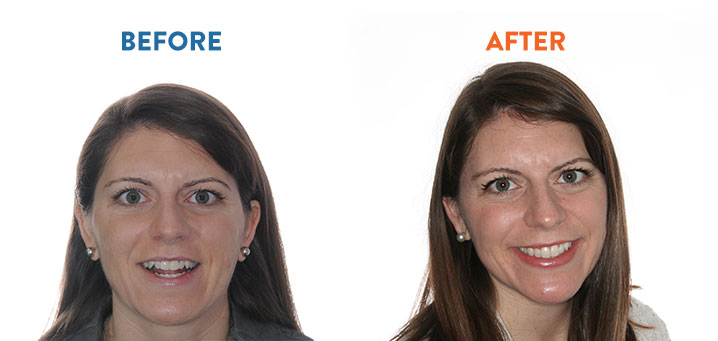 Hudson Orthodontics - Before and After Orthodontic Treatment